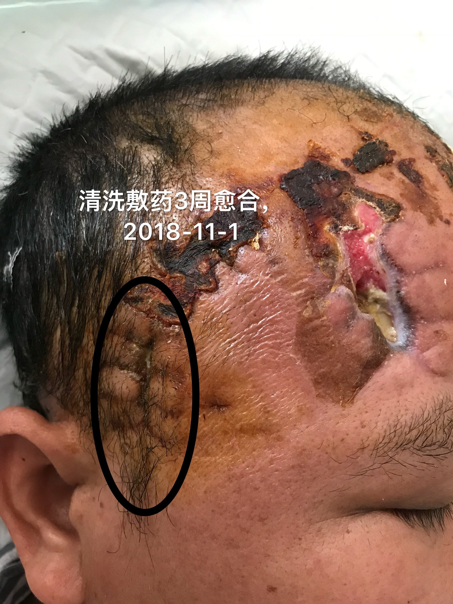 物理医学与康复_跟腱撕裂保守治疗康复_康复物理治疗