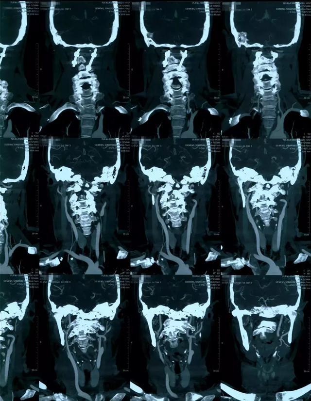 病例点评:寰枢椎脱位1例 - 好大夫在线
