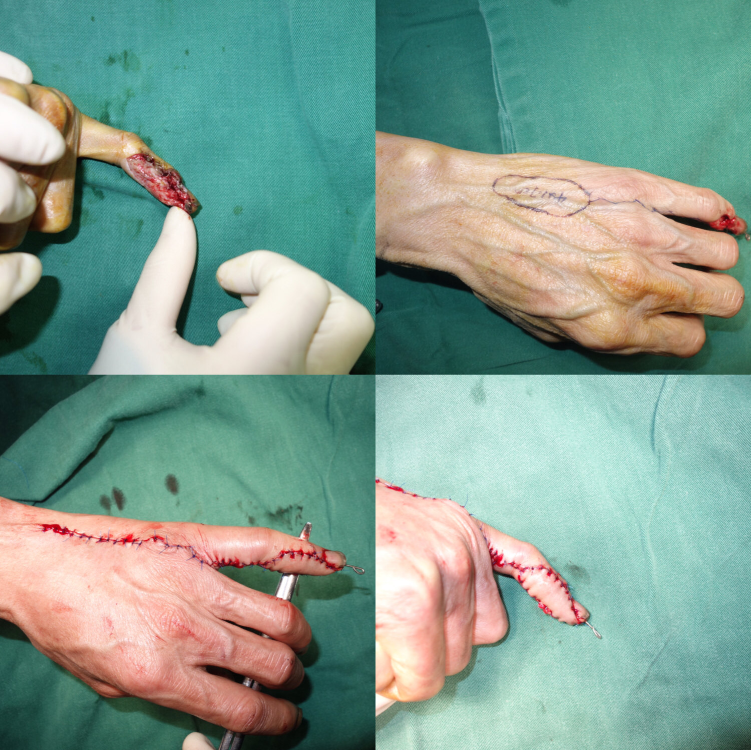 手指皮瓣手术后期整容图片