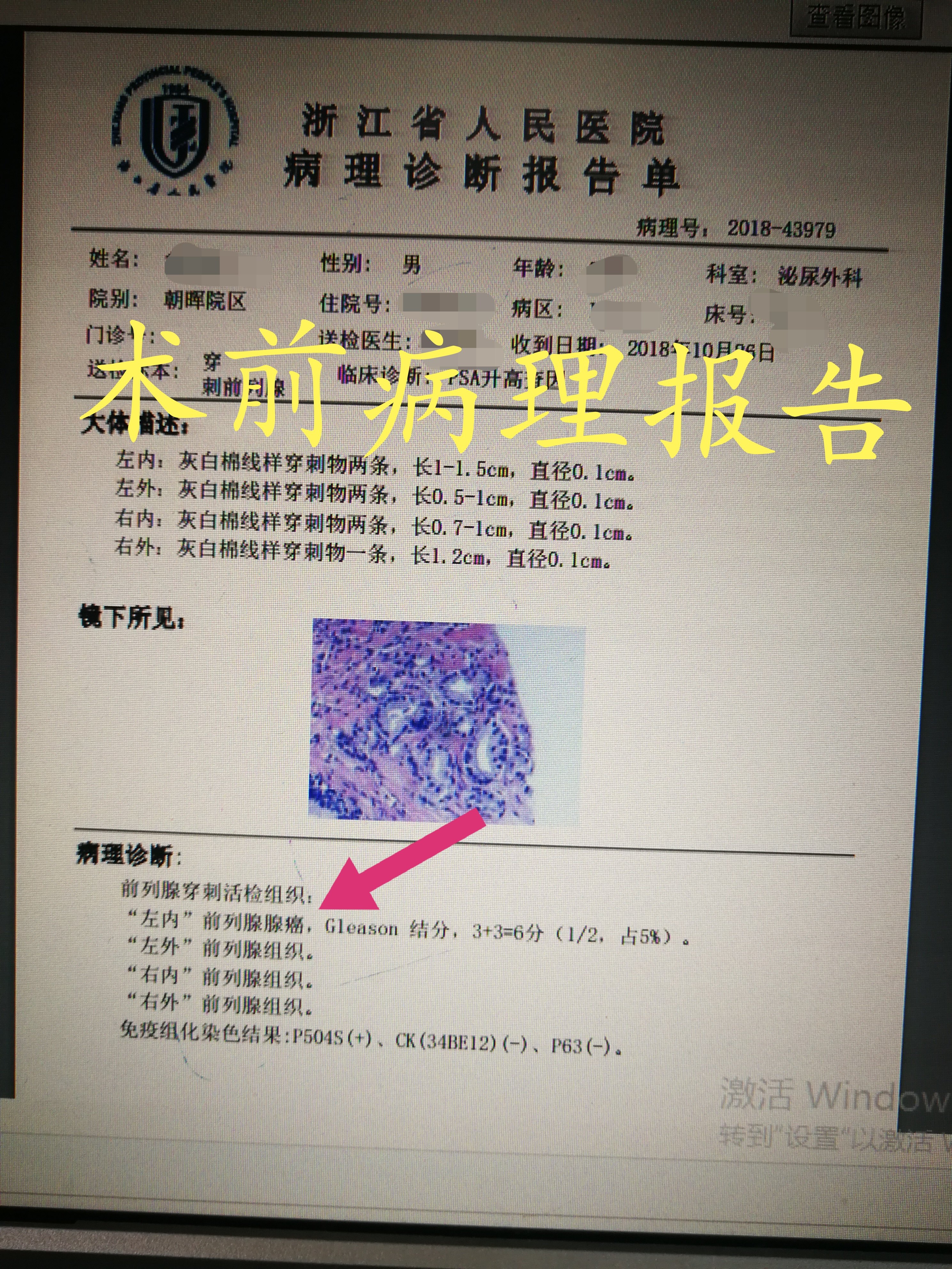 沃医生主刀手术13:腹腔镜前列腺癌根治术-三孔法 - 好大夫在线