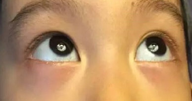 遗传是该类眼袋的主要成因,眼袋靠近下睑缘,无明显垂坠感,无皮肤松弛.