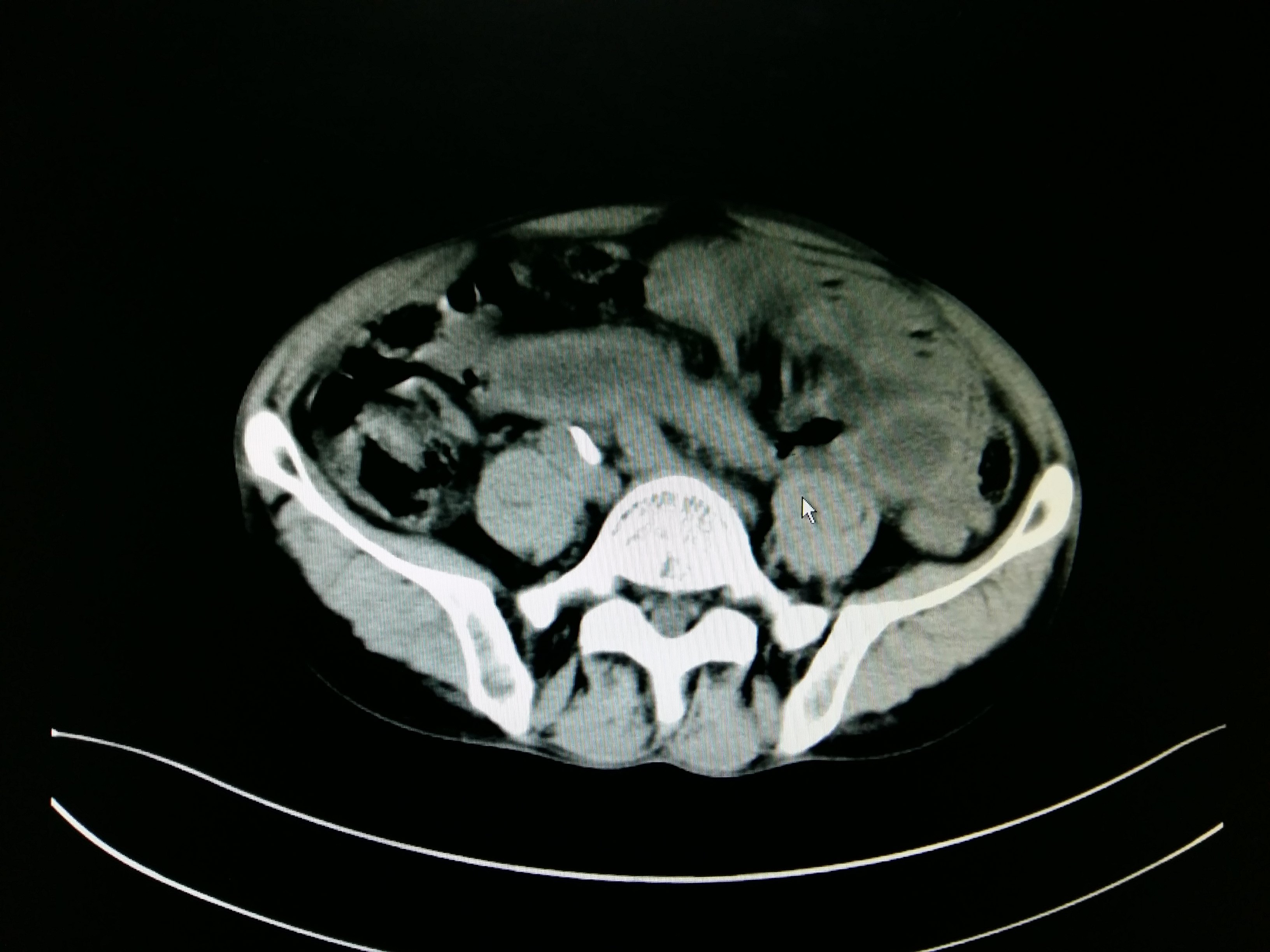 肠系膜扭转ct表现图片图片