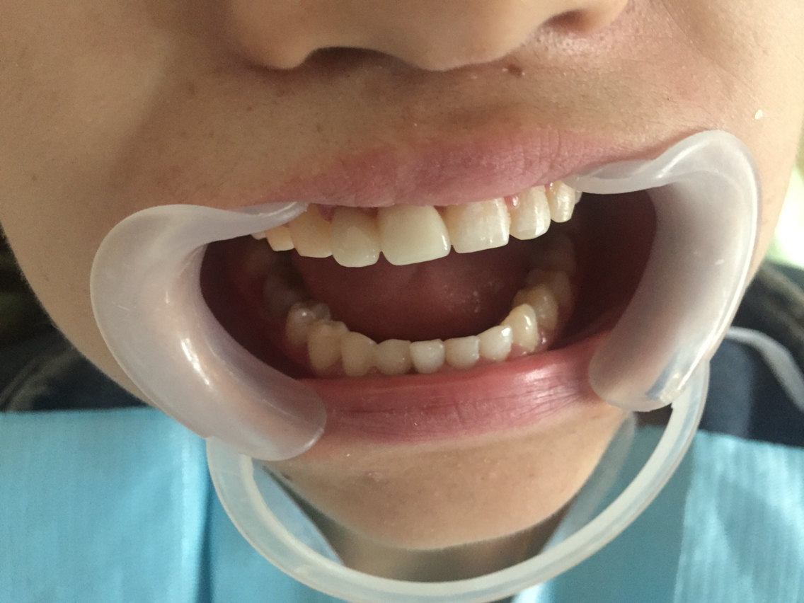 牙齿中线偏斜求矫正