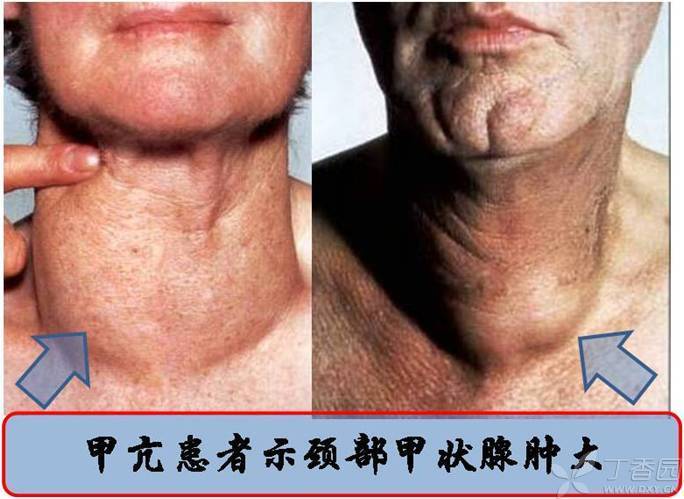 得了甲亢是怎么回事?会出现哪些症状?