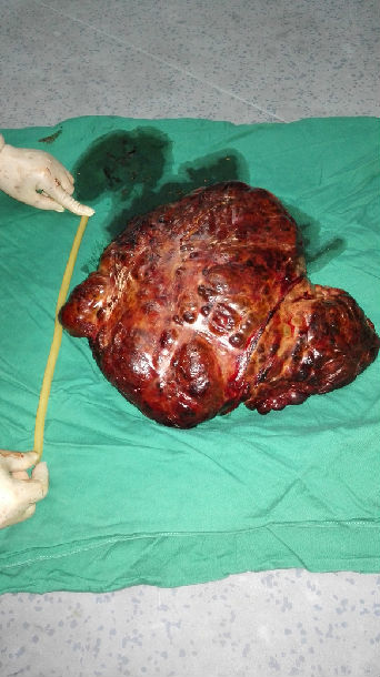 弥漫性肝癌,切除肝脏重量16斤(正常1000克) - 好大夫在线