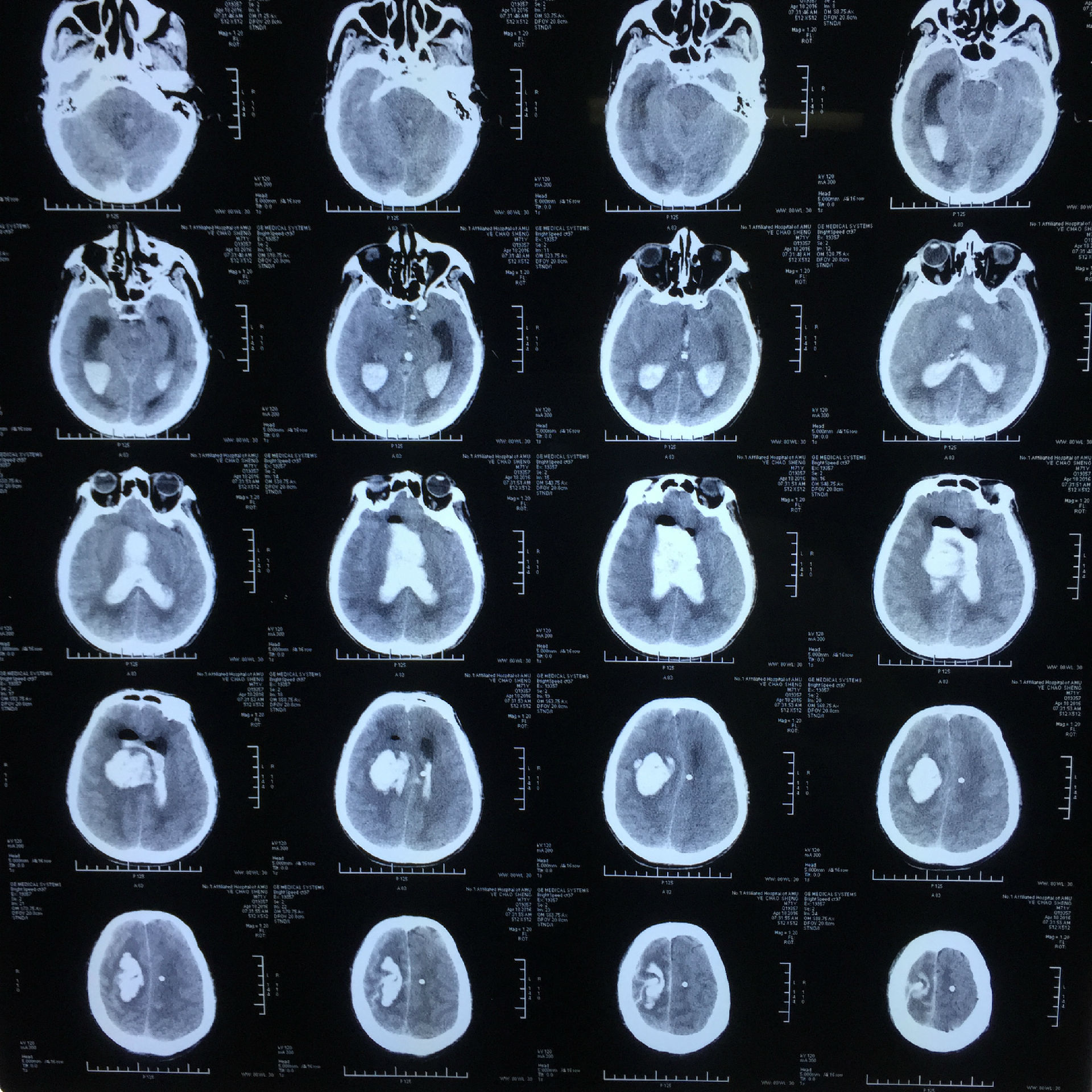 但对于出血破入脑室铸型者,效果极差,死亡率50-70%,而神经内镜下直接