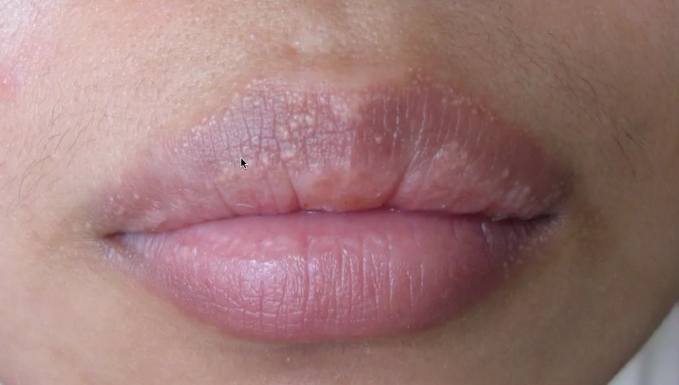 有图有真相:嘴唇上的丘疹是什么病?