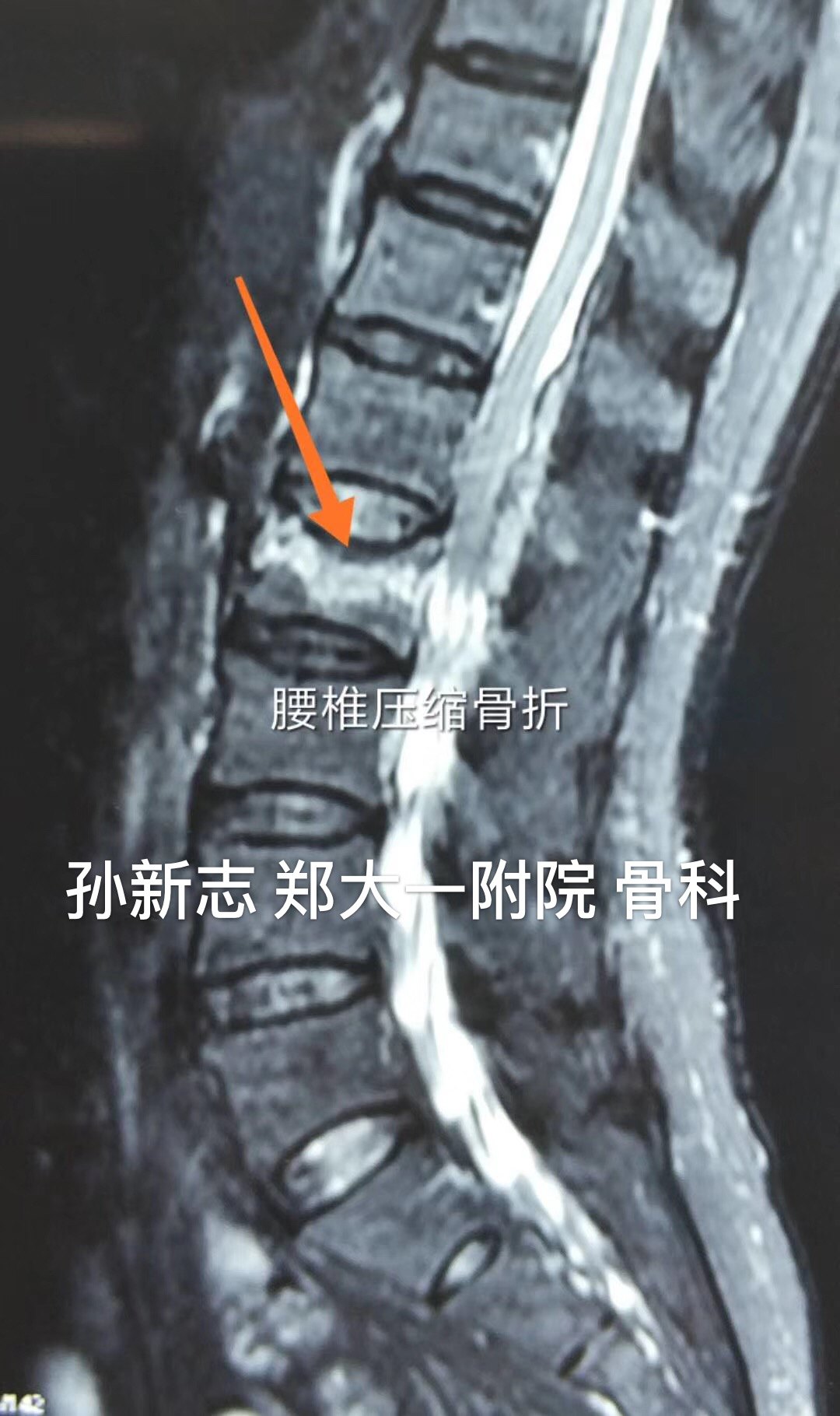 孙新志教授 微创手术治疗骨质疏松 病例