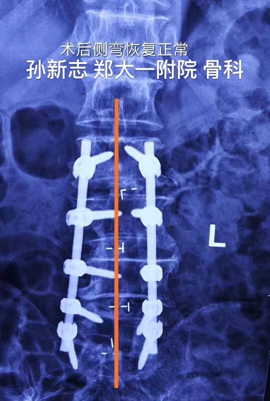 孙新志教授:腰椎管狭窄脊柱侧弯—-病例13 - 好大夫在线