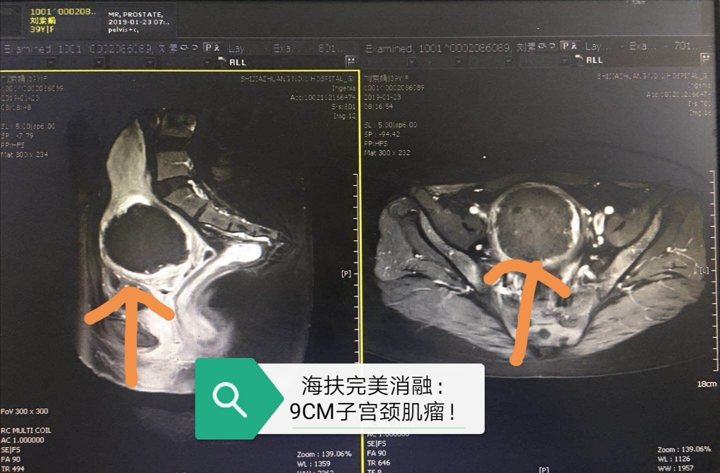 子宫肌瘤做海扶治疗前为什么要做核磁共振检查