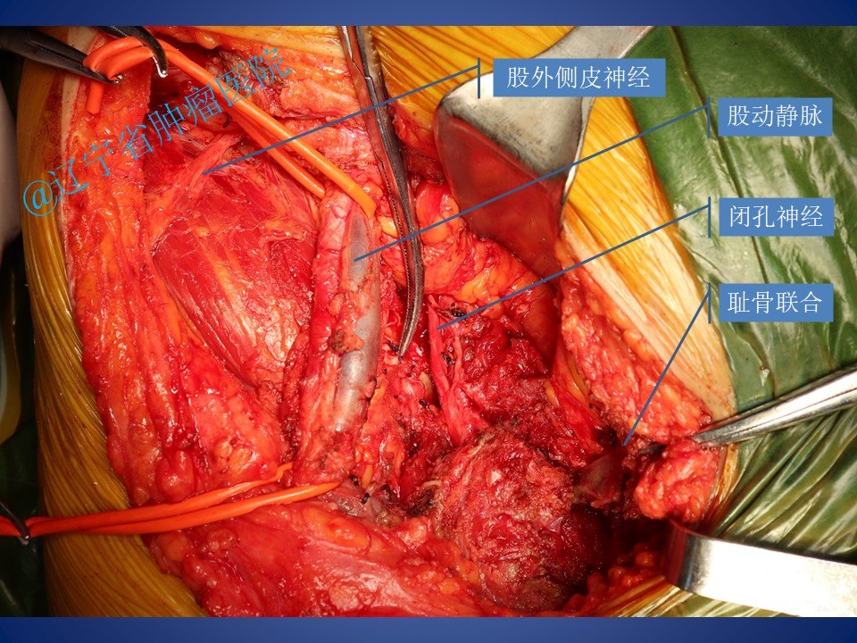 骨盆耻骨肿瘤切除手术病例 - 好大夫在线