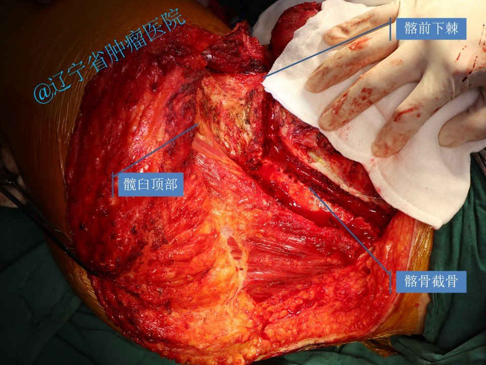 骨盆髂骨肿瘤髂骨次全切除术病例 - 好大夫在线