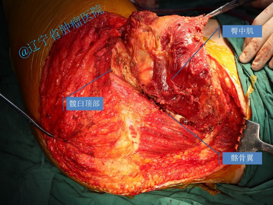骨盆髂骨肿瘤髂骨次全切除术病例 - 好大夫在线