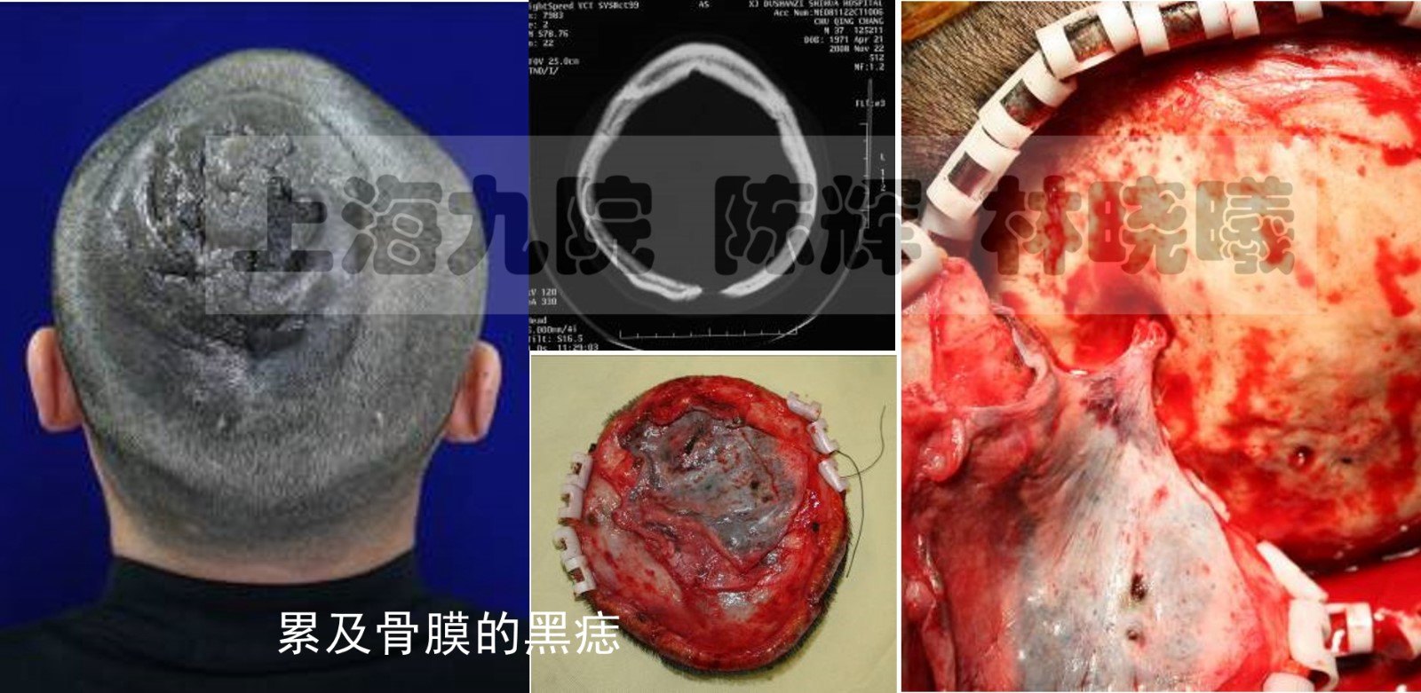 黑色素痣痣關重要的診療常識多圖詳解