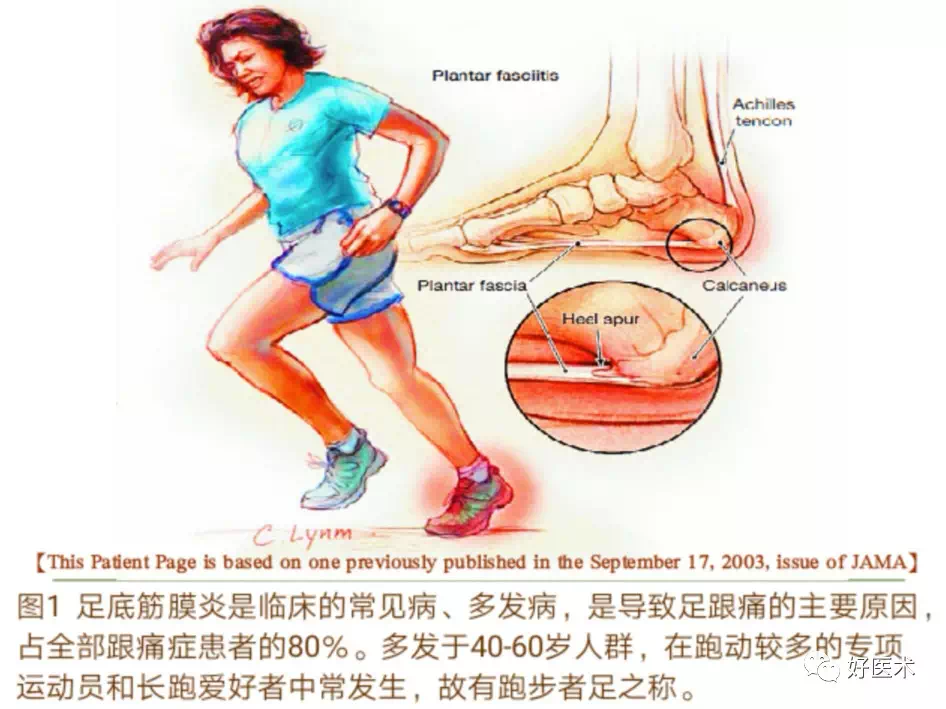 足跟痛跖筋膜炎
