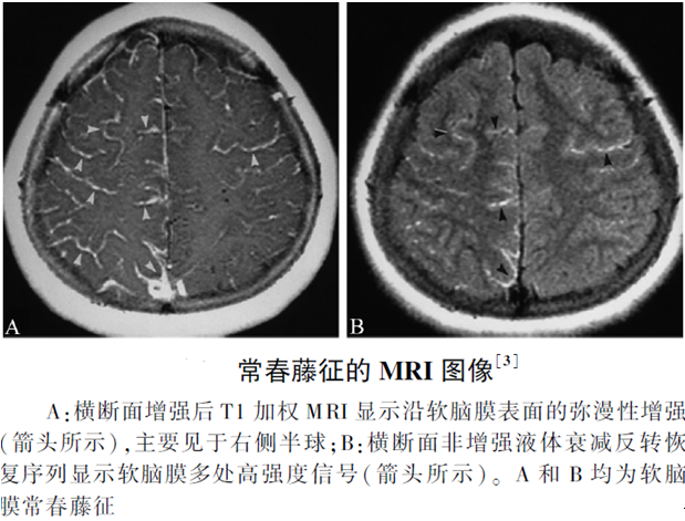 烟雾病