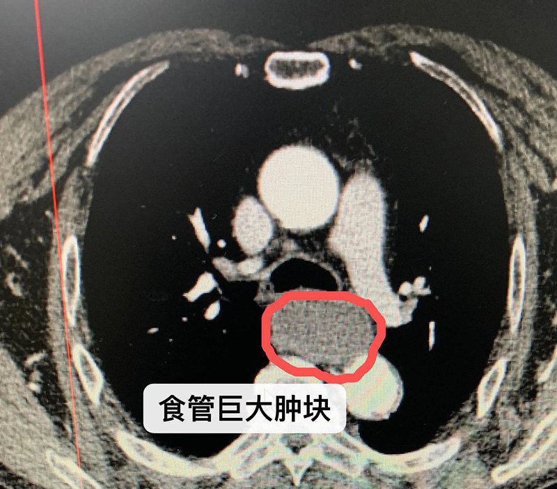食道癌_症状_症状表现 - 好大夫在线