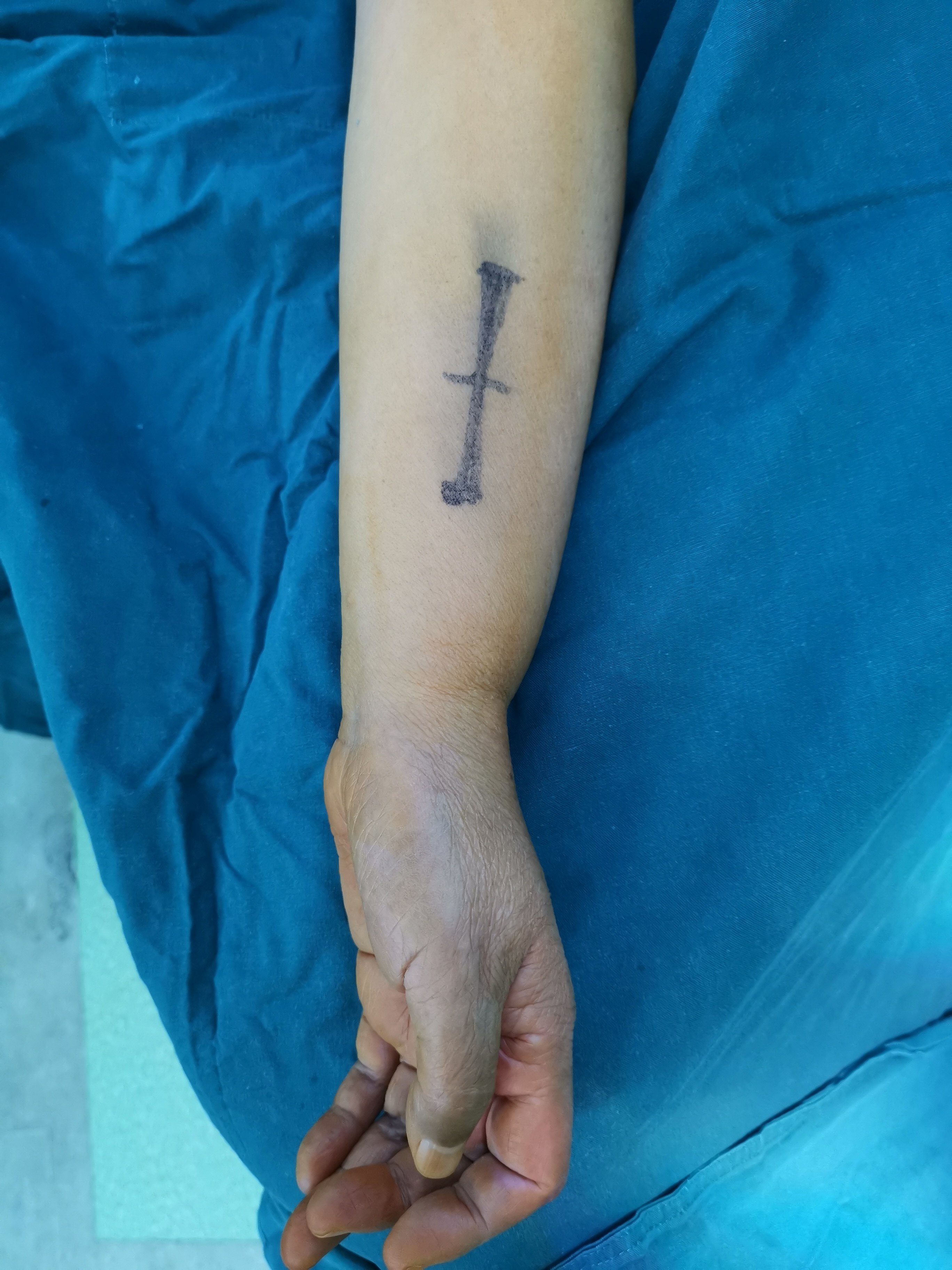 桡神经浅支卡压综合征病例分享 - 好大夫在线