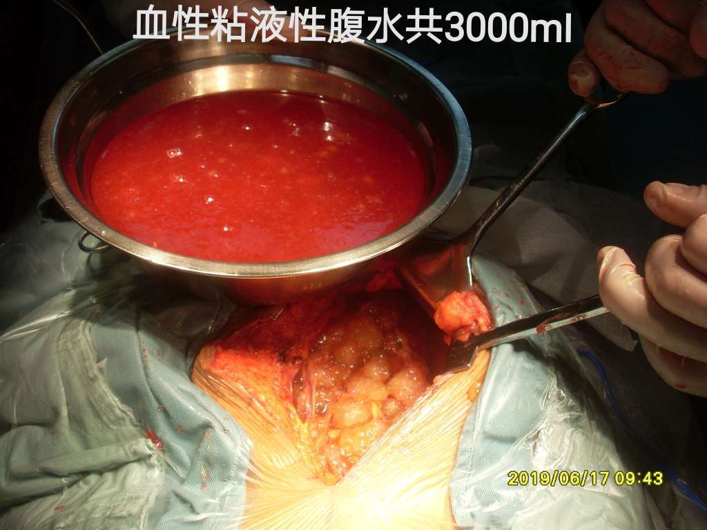 病例79以腹水查因诊断为pmp未曾手术即为晚期