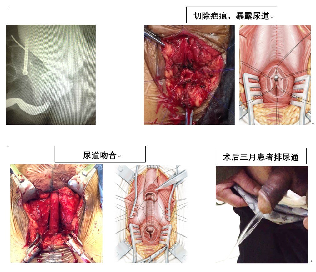 尿道口狭窄手术图片图片