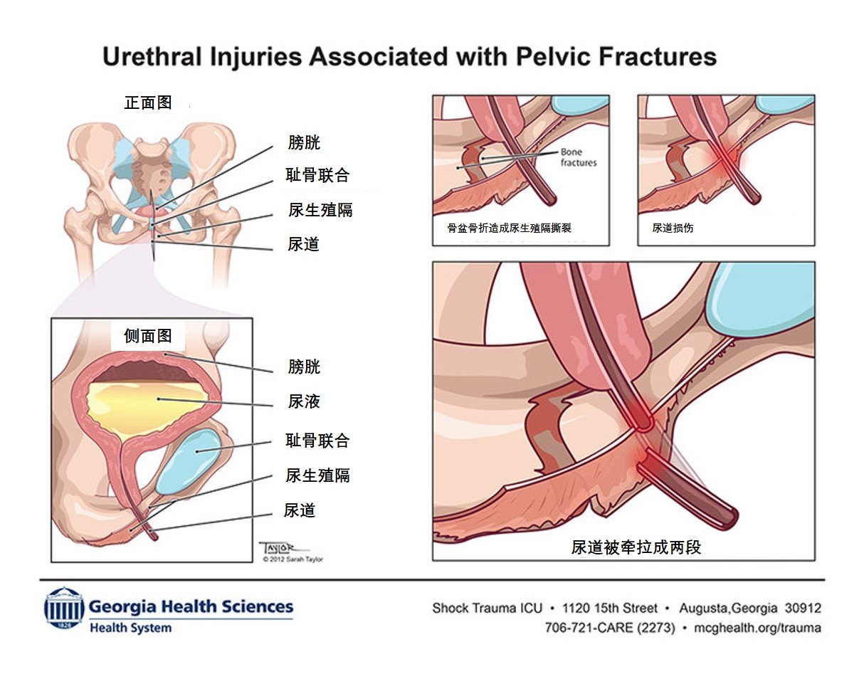 骨盆骨折 后尿道损伤 勃起功能障碍 尿路梗阻 病因 治疗方法 好大夫在线