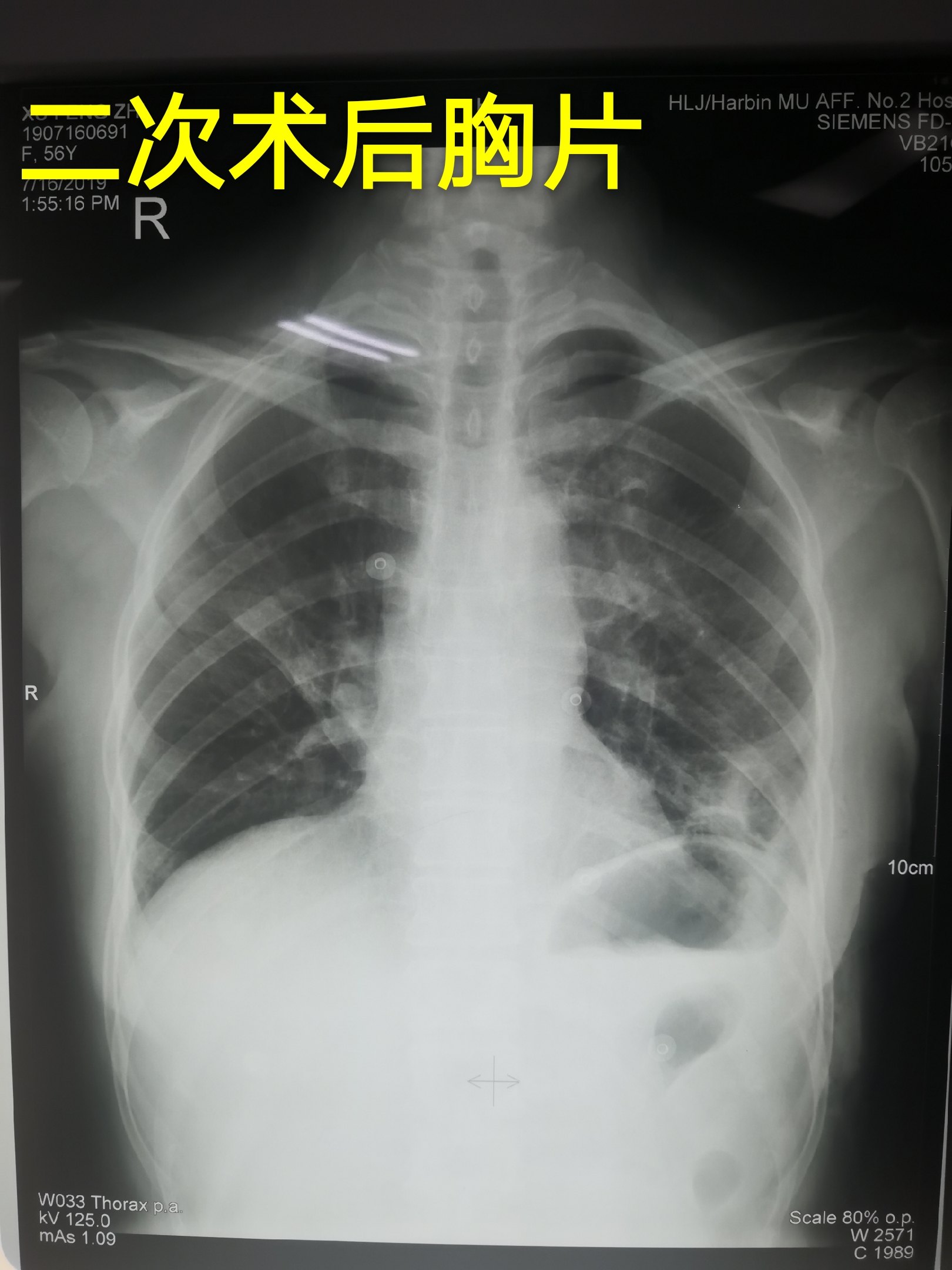 _左下肺肺纤维化病灶图片_有来医生