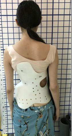 脊柱侧弯?这份青少年脊柱健康的守护指南请查收