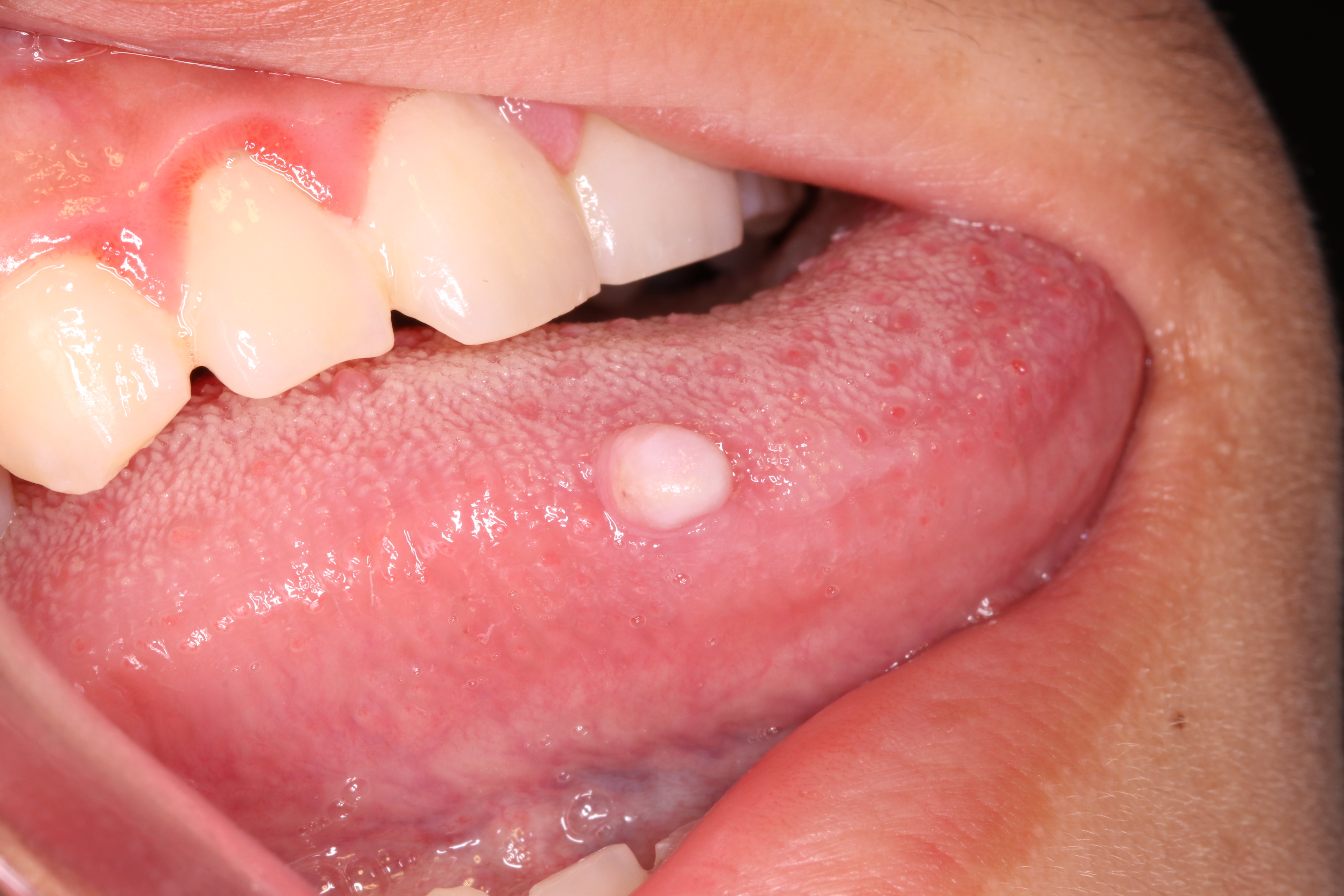 舌头上的小白疱是舌癌 舌癌 症状 手术 好大夫在线