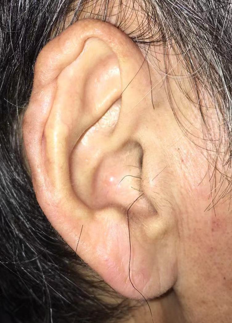 耳廓软骨膜炎怎么治疗图片