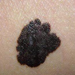 黑毛痣一定要及时治疗,它影响的不仅仅是健康