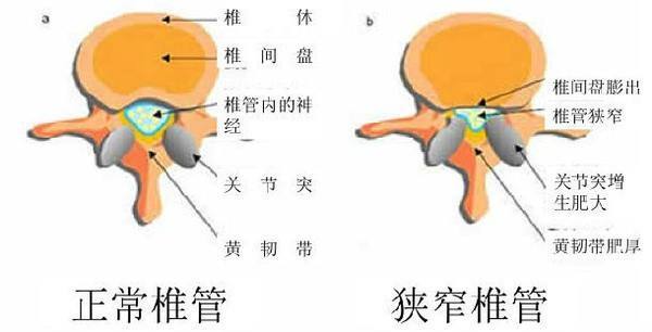 正常椎管和狭窄椎管对比.jpg