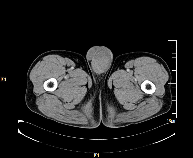 阴囊皮下脂肪瘤左侧附睾囊肿直径超过睾丸,临床上比较罕见,而且患者