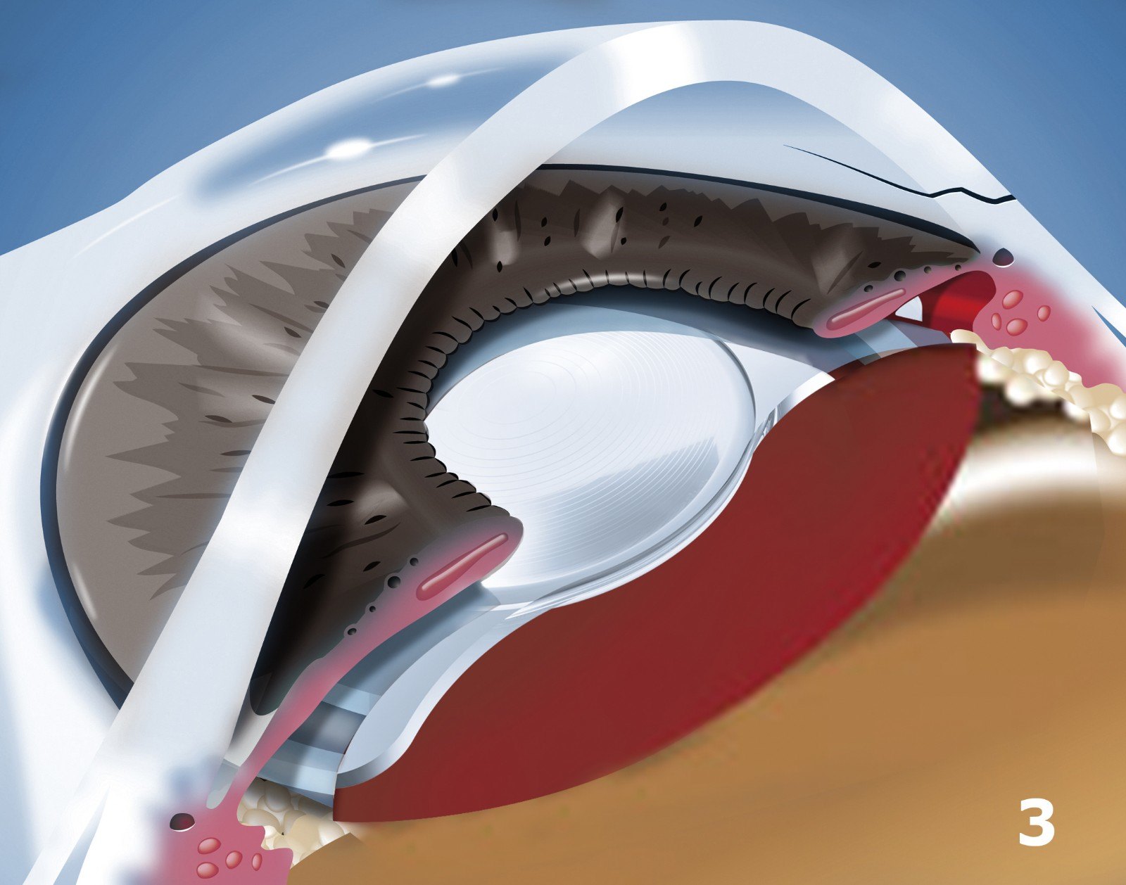 手术全程在显微镜下进行,利用注射方式将人工晶体折叠注入眼内后展开