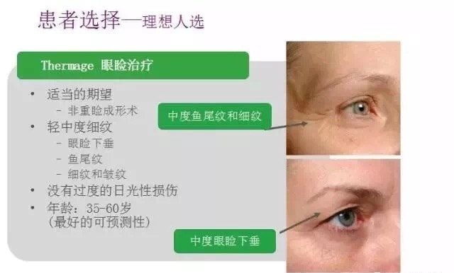 热玛吉眼睑治疗 除皱 除皱治疗方法