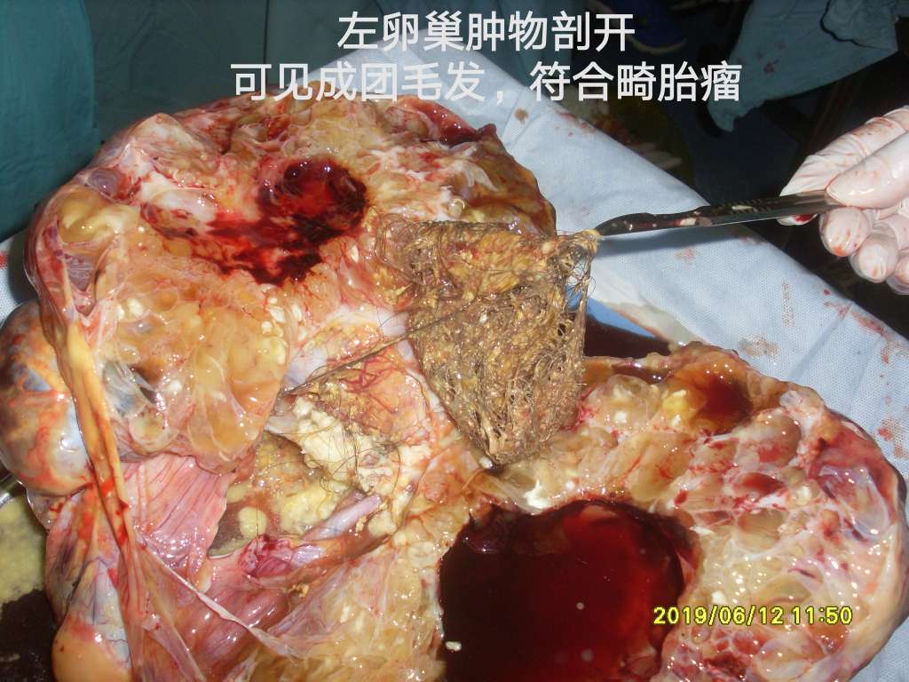 6 实施方案:考虑成熟性畸胎瘤多为良性或交界性,故决定行子宫,双附件