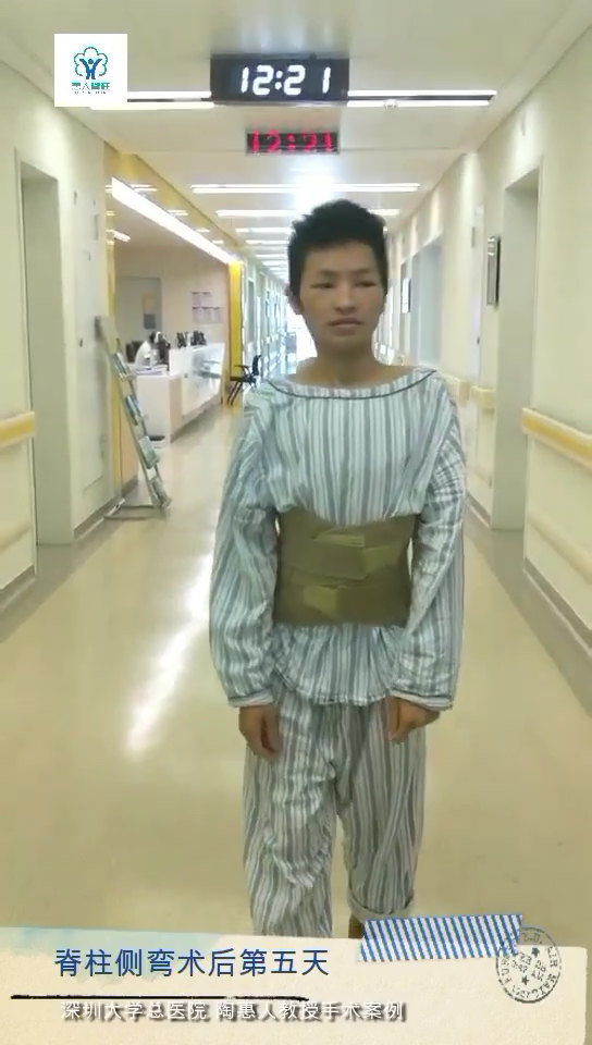 脊柱侧弯手术后第五天 陶惠人教授手术案例
