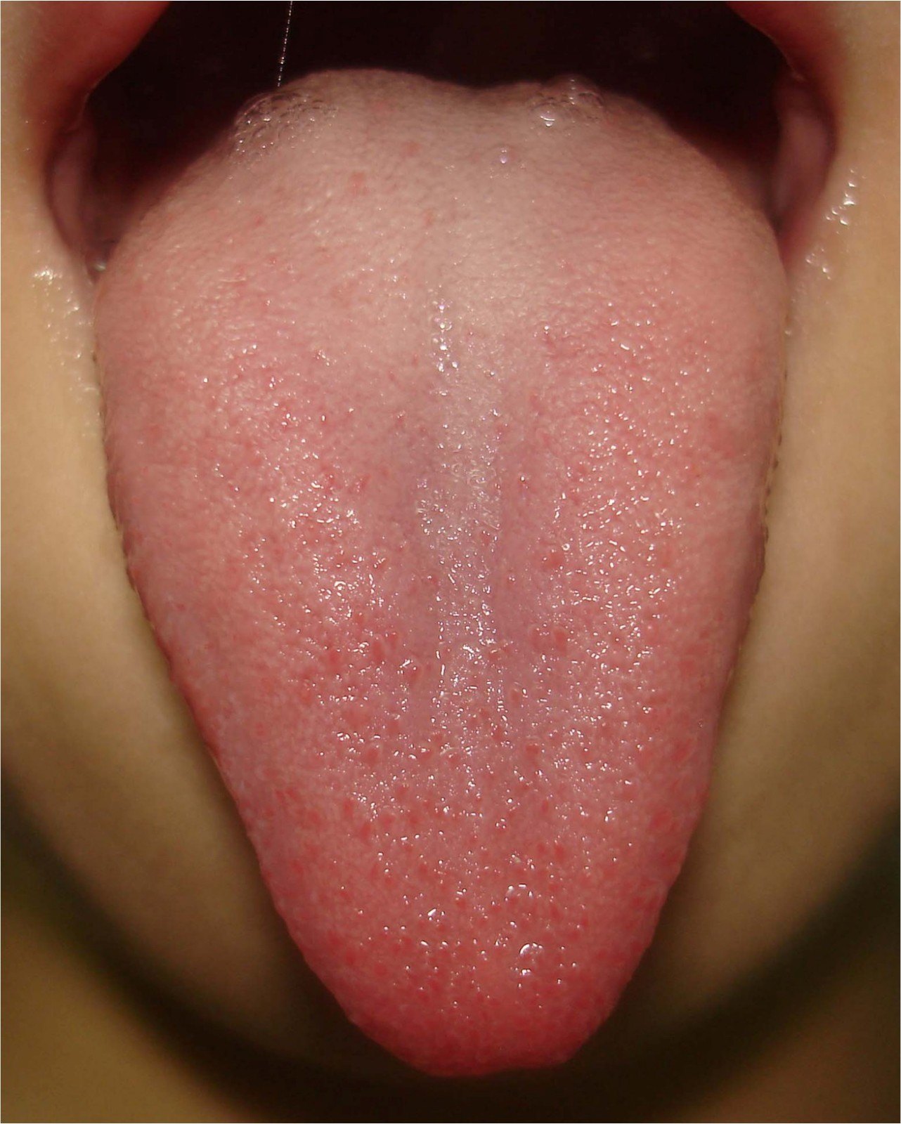 正常人的舌尖红点图片图片
