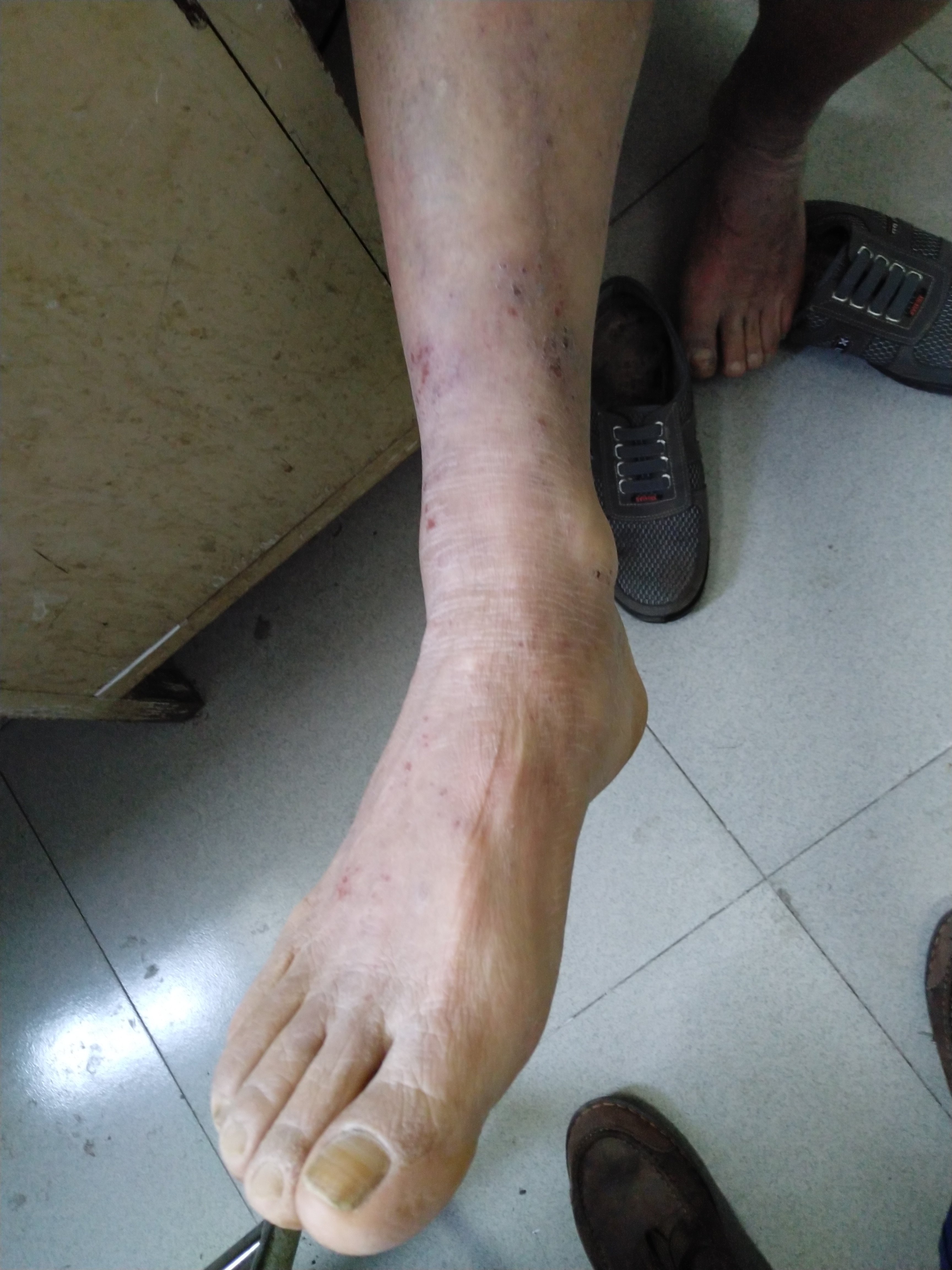 过敏性鼻炎急性鼻炎_急性过敏性鼻炎能治好吗_急性过敏性鼻炎可以自愈吗