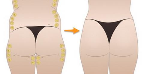 【刀锋论坛-脂肪】 如何打造女性腰臀"s"型曲线