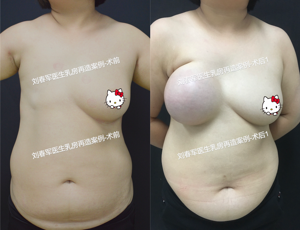 无中生有 之乳腺癌术后乳房再造 7个案例看效果 有血有肉有感觉的乳房 乳房整形 手术