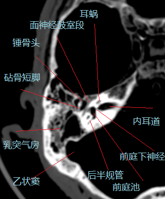 颞骨的位置图ct图片