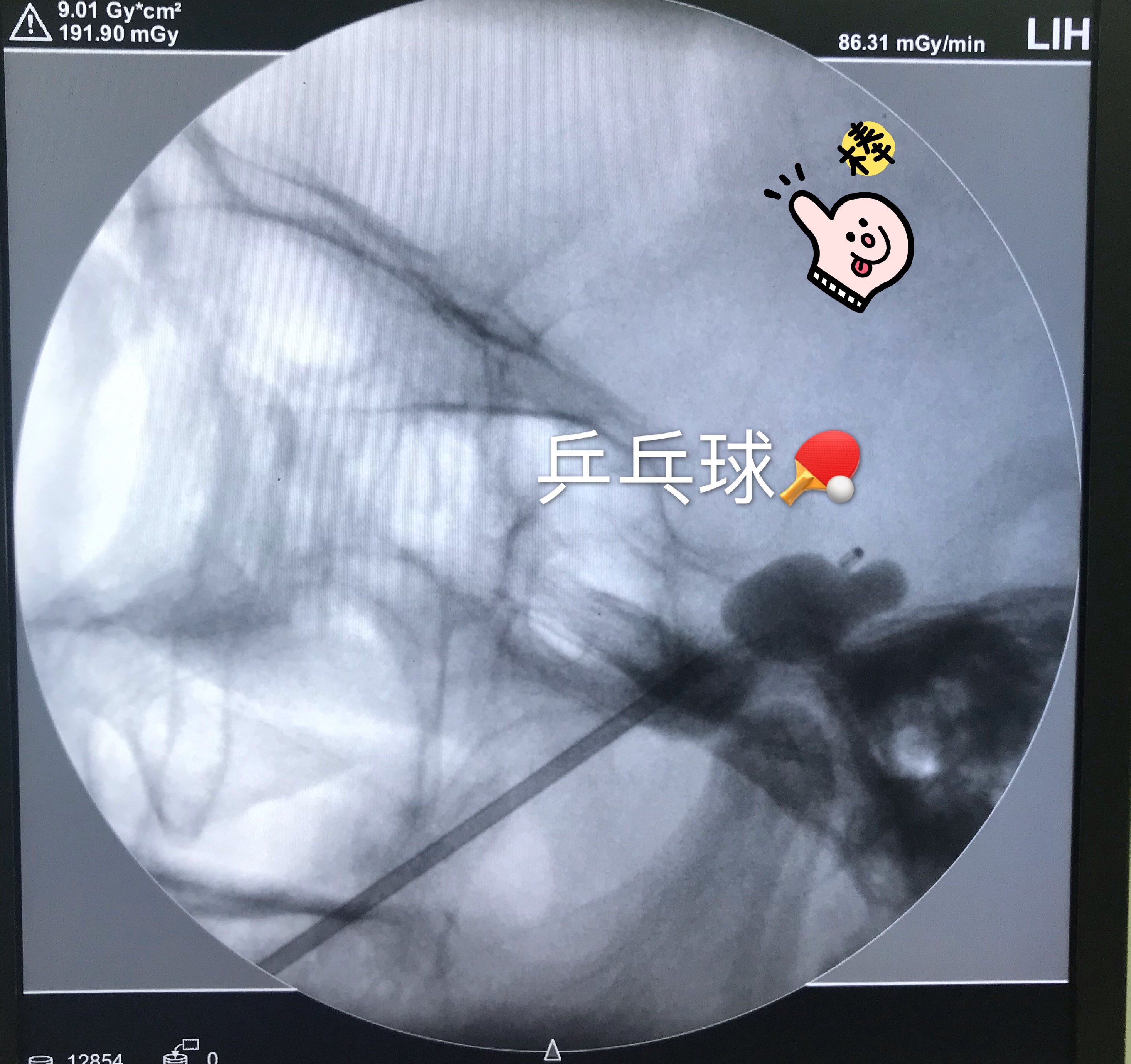 球囊助产图片