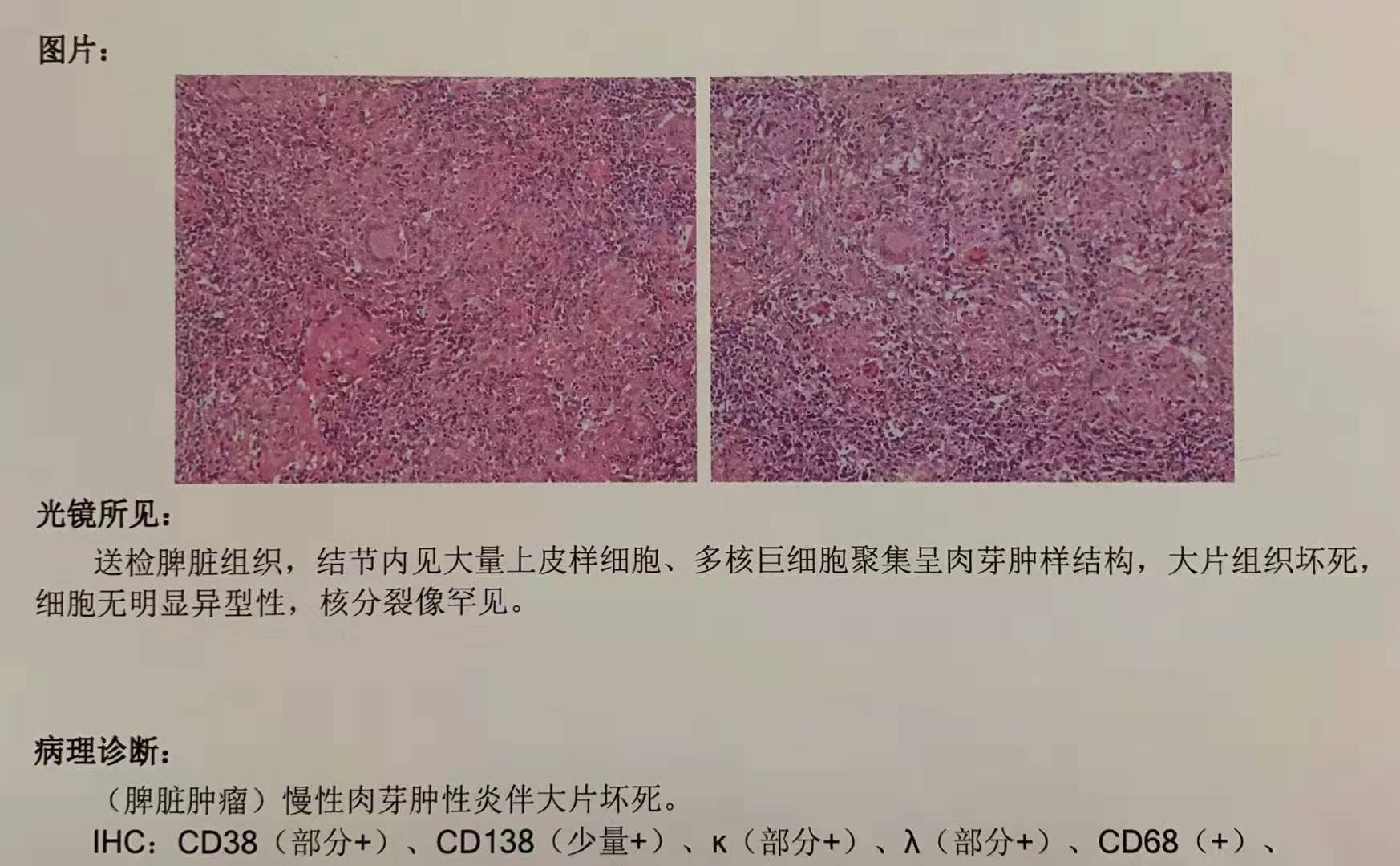 腹腔鏡脾部分切除術_腹腔鏡手術_手術_治療介紹 - 好大夫在線