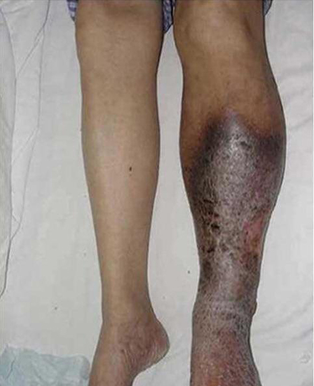 腿部血栓的症状图片图片