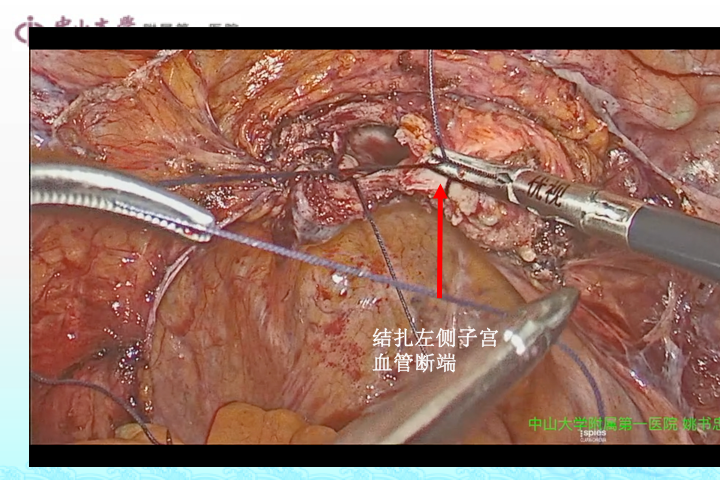 宫外孕手术过程图片