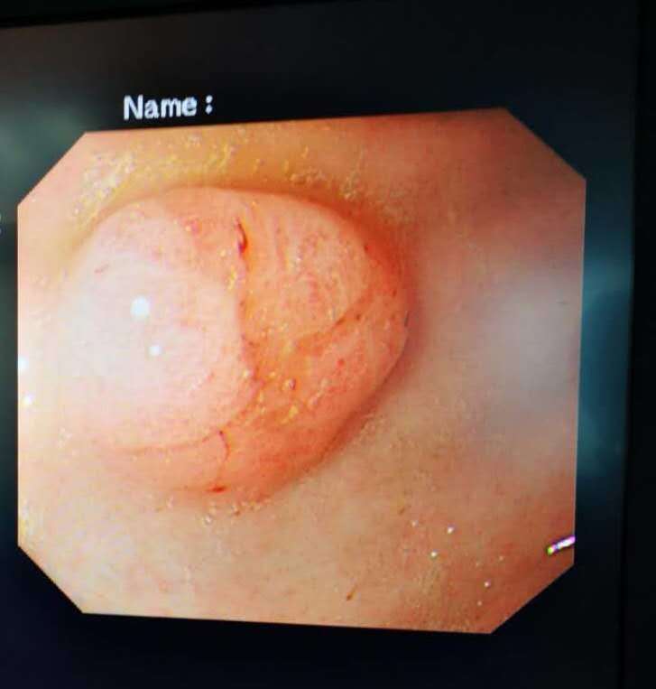 胃癌图片实拍 症状图片