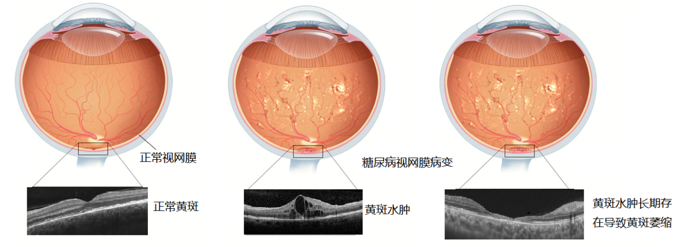 糖尿病黄斑水肿的最新治疗进展
