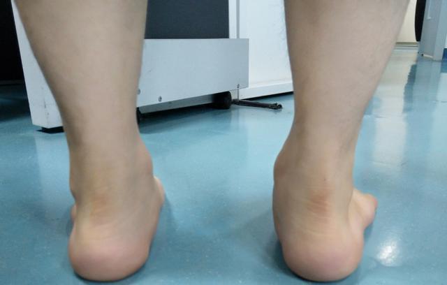 扁平足/如何筛查扁平足?以下有几个方法教您!