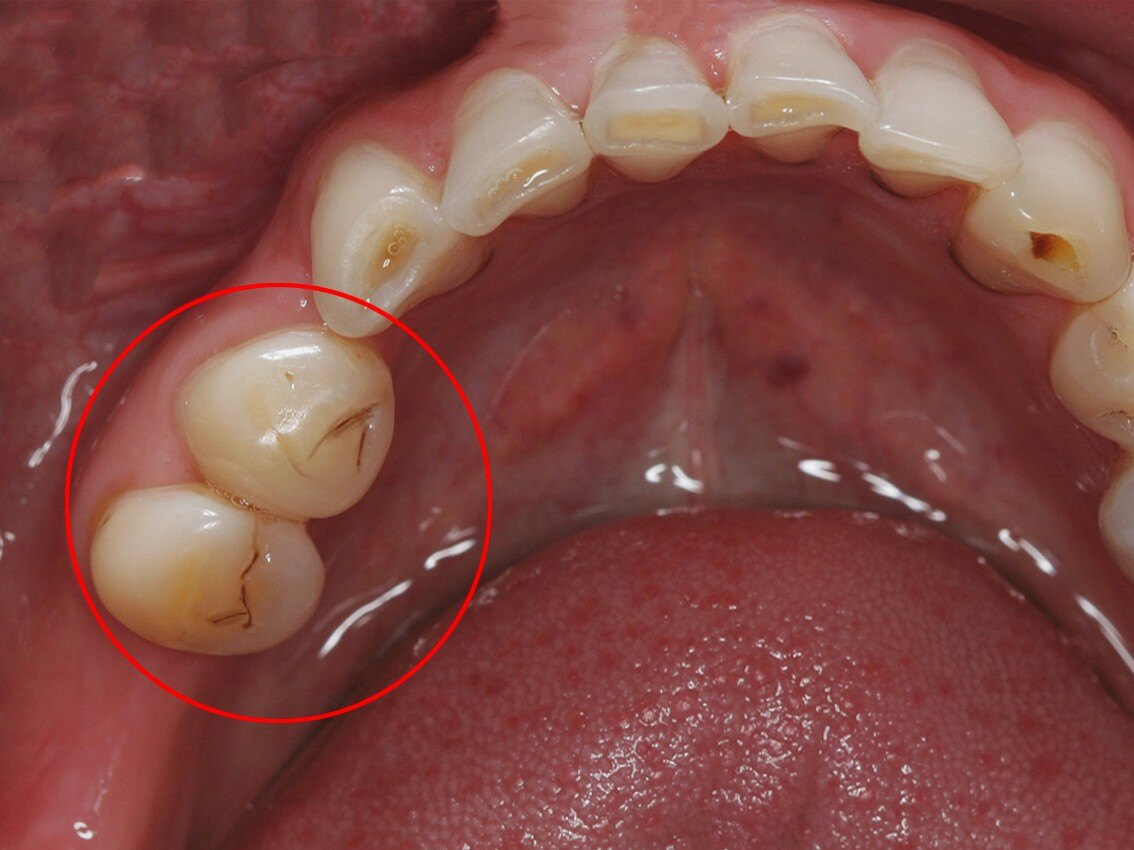 牙齿上面的黑线是什么? 