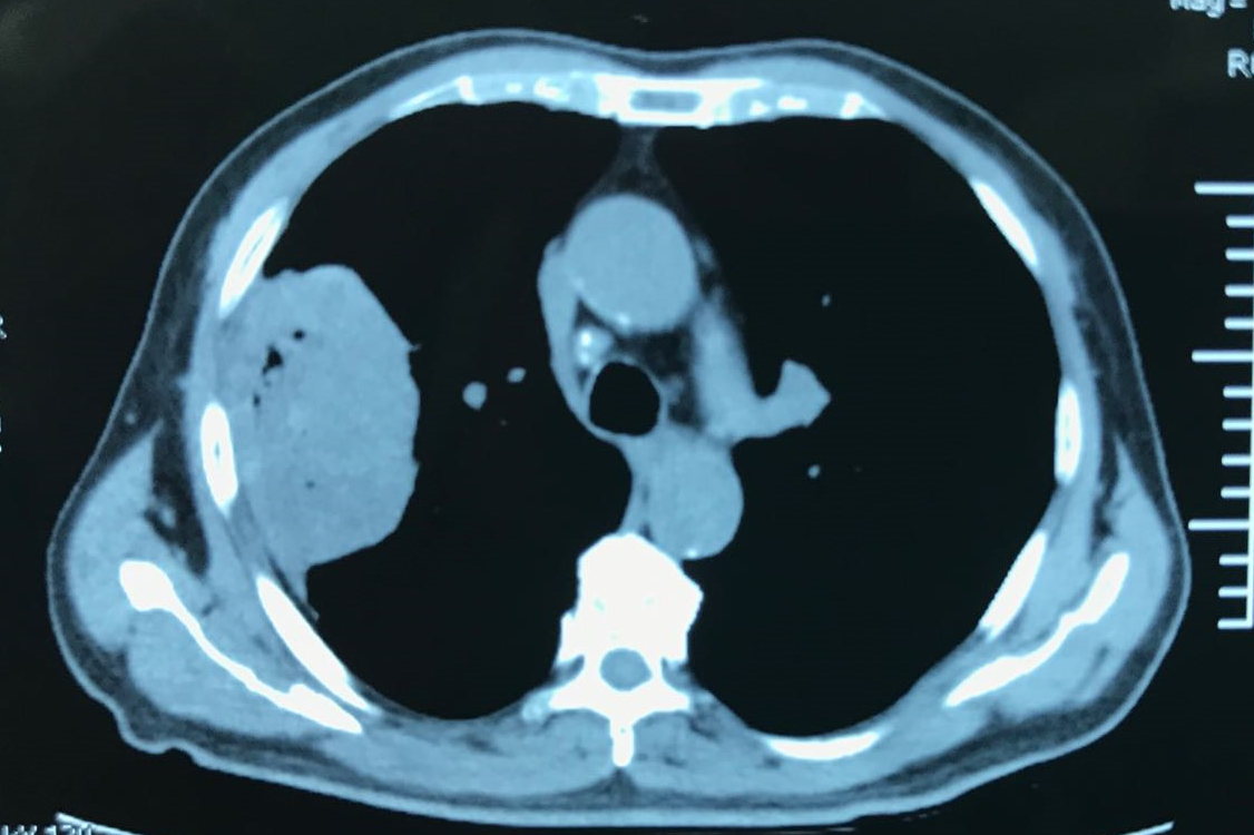 外科治疗中的优势大的肿瘤或者又大又累及胸壁的肿瘤就没法微创了吗?
